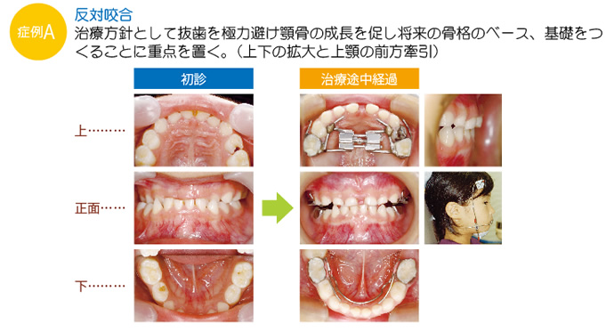 症例A 反対咬合(治療方針として抜歯を極力避け顎骨の成長を促し将来の骨格のベース、基礎をつくることに重点を置く。(上下の拡大と上顎の前方牽引))