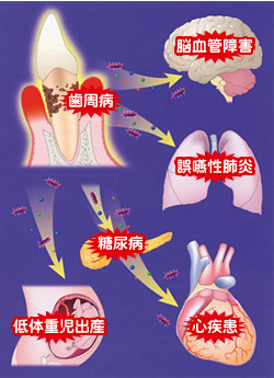 歯周病菌の全身への影響