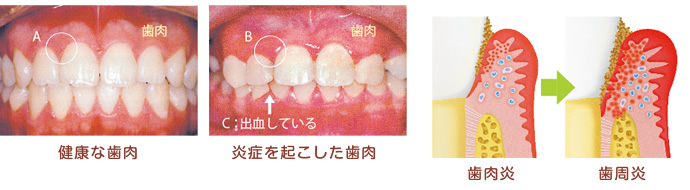 歯肉炎 歯周病 いぶすキッズ子育て支援情報サイト 鹿児島県指宿市の子育て支援情報